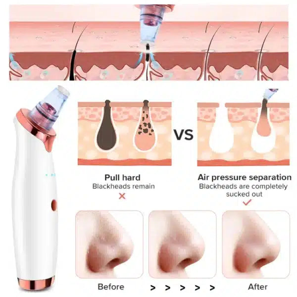 Vacuum Blackhead Remover Face Black Spots Cleaner White Dot Pimple Removal